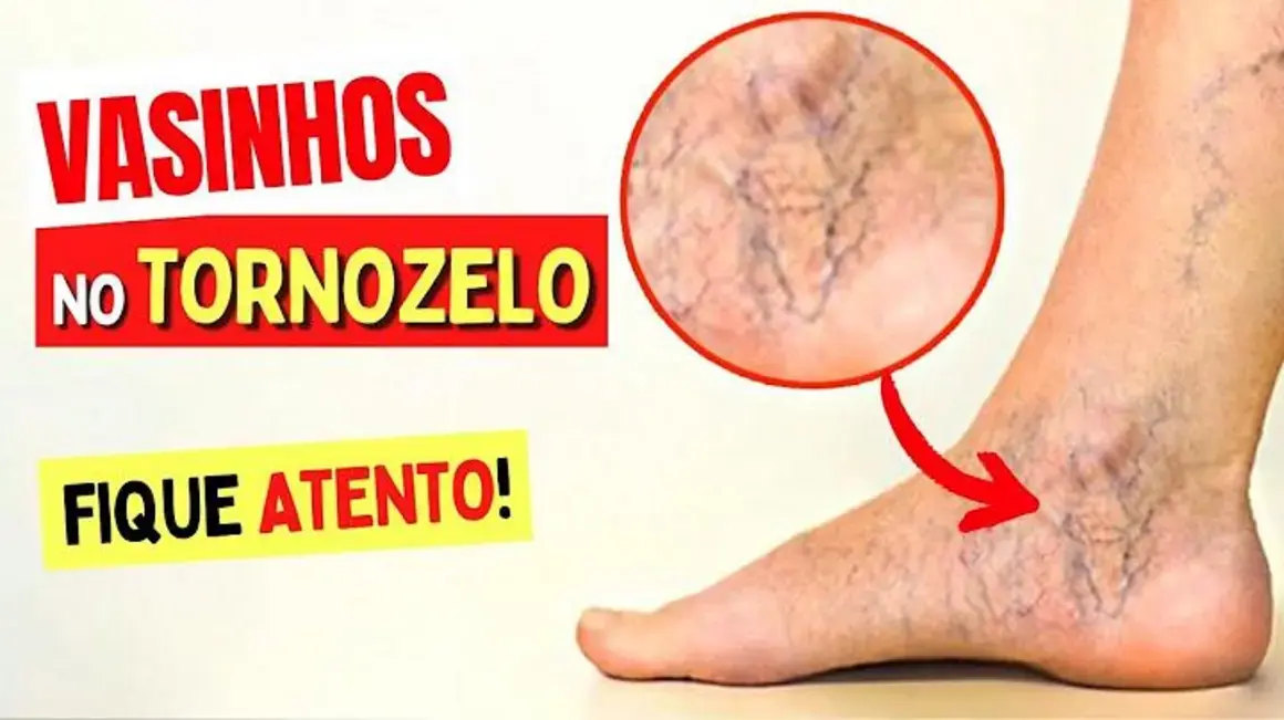 Receita de Vazinhos no Tornozelo: Como Identifiquei Sintomas e Cuidei de Mim