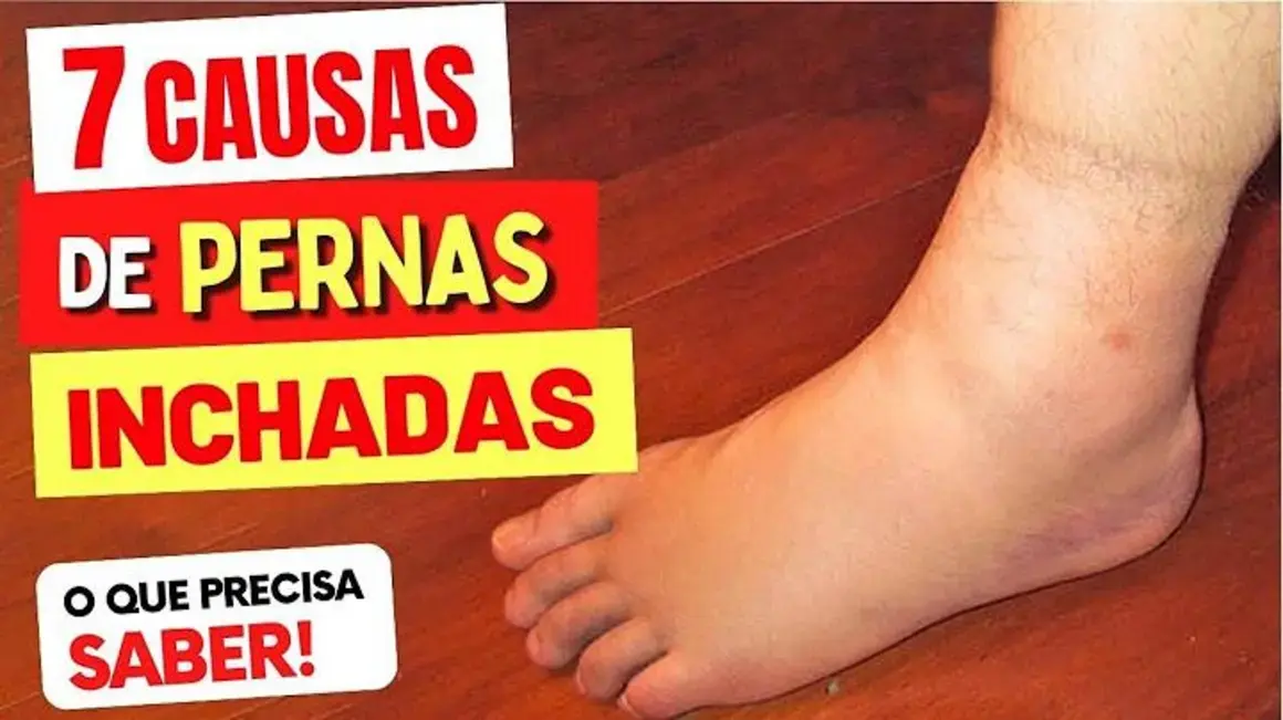 Receita de Pernas Inchadas: 7 Causas e O Que Fazer Para Melhorar